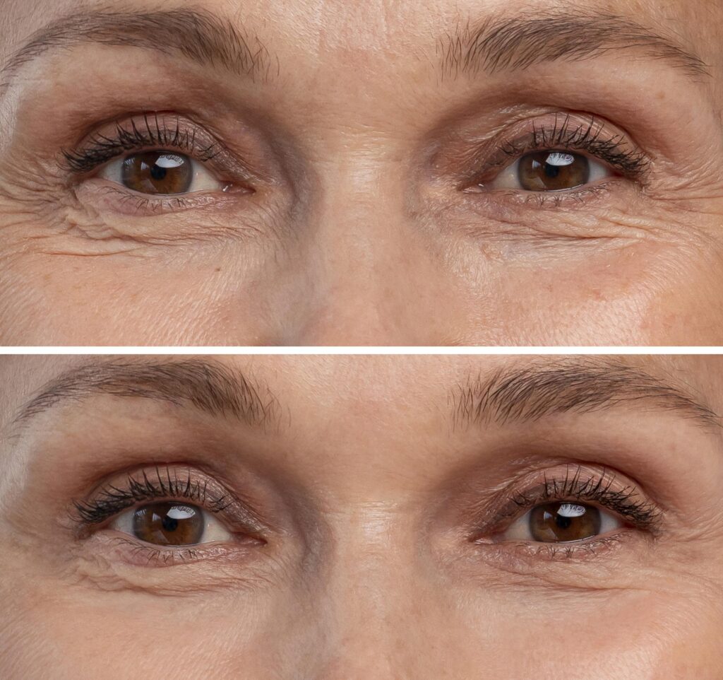 Wrinkles ? Best Treatment: Code Aesthetics Guide to Timeless Skin