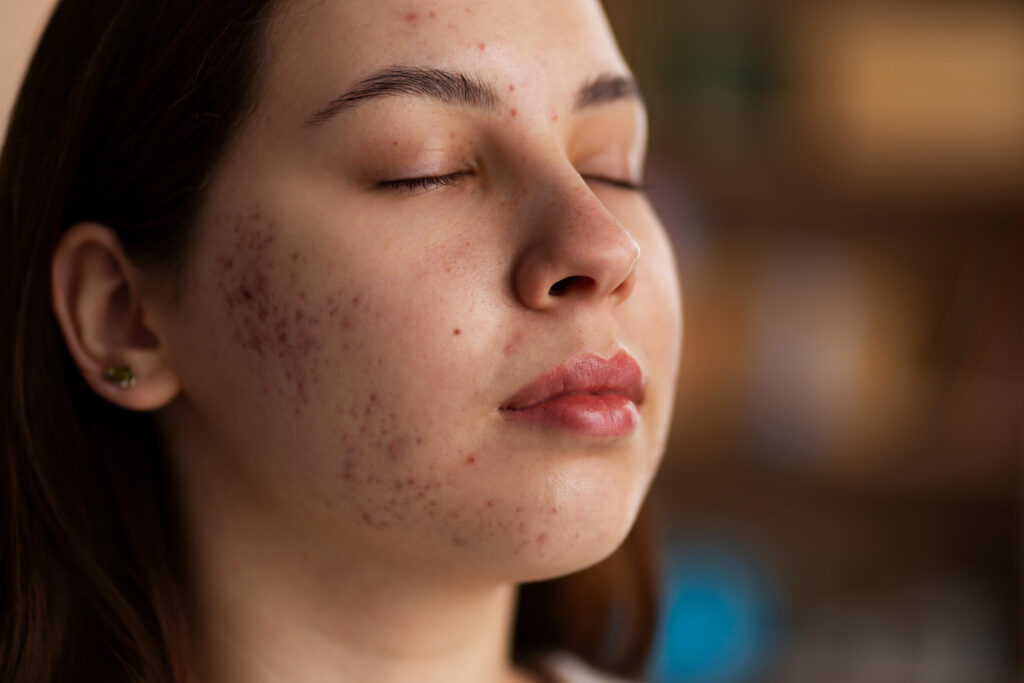 PICODE Laser: Best Skin Rejuvenation and Pigment Removal